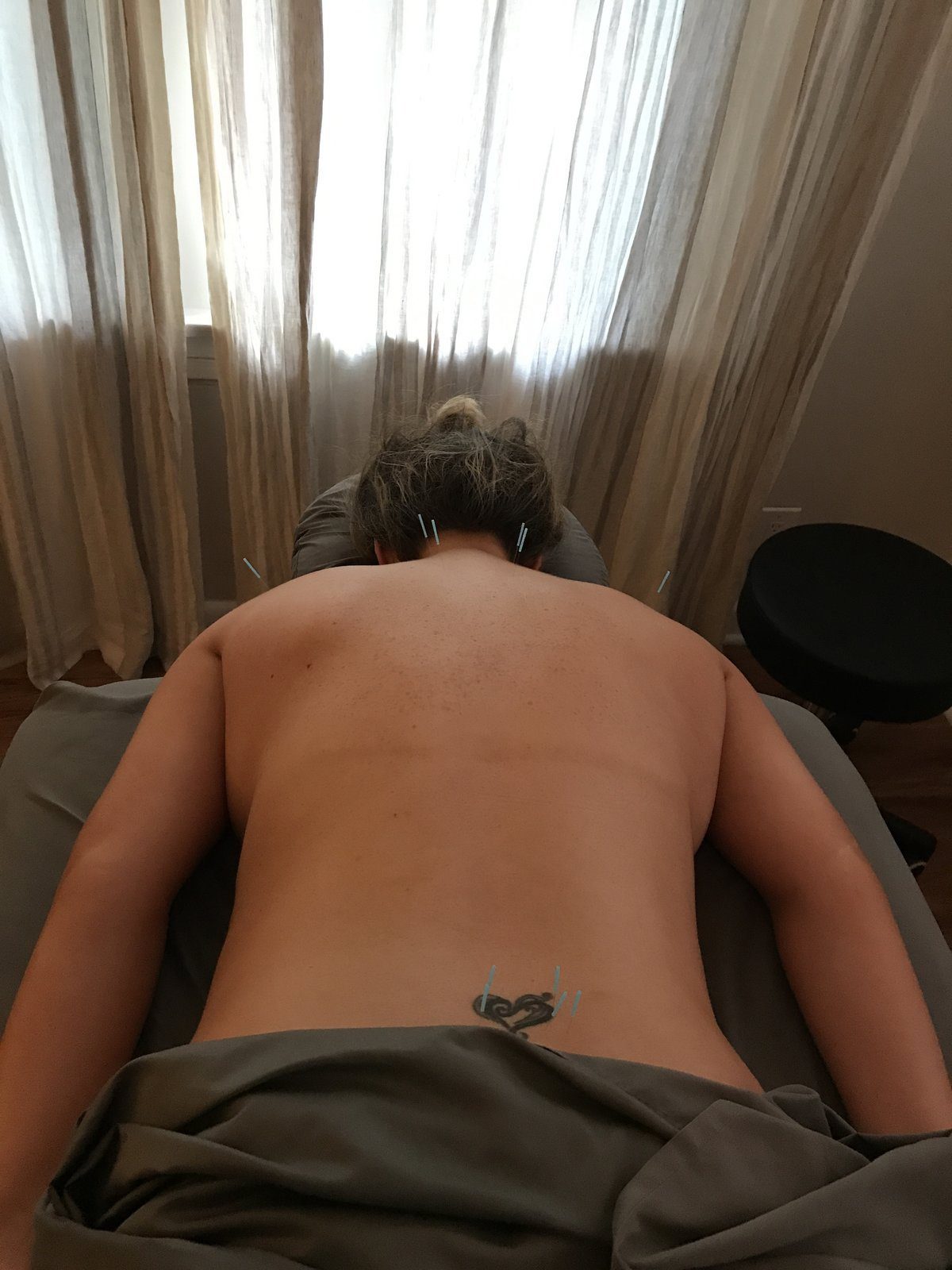 Acupuncture and cupping